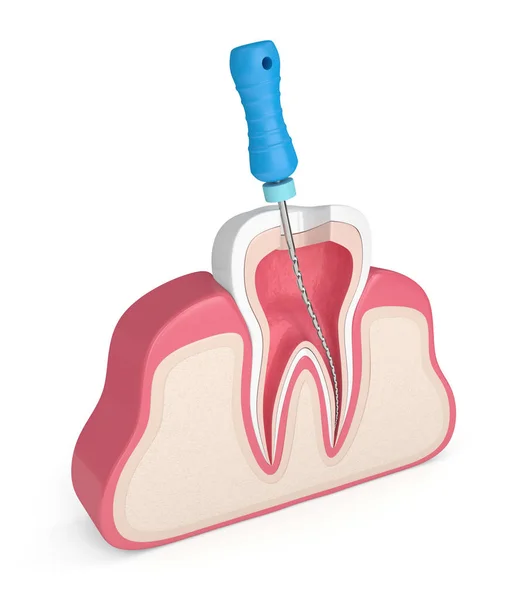 3d render of tooth with endodontic file in gums — Stock Photo, Image