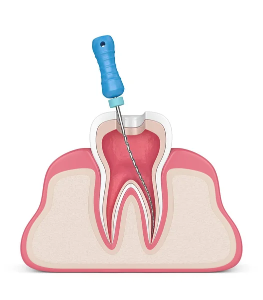 Rendering 3d del dente con file endodontico nelle gengive — Foto Stock