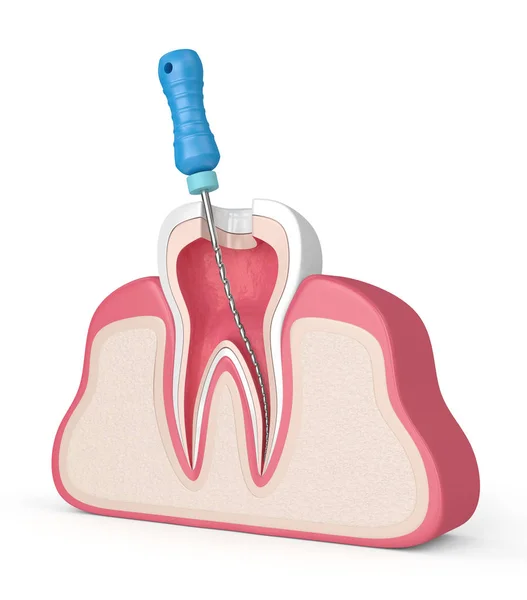 3d renderizado de diente con lima endodóntica en encías — Foto de Stock