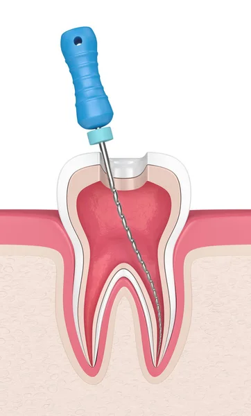 3D render van tand met endodontische bestand in tandvlees — Stockfoto