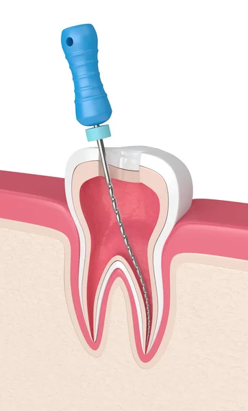 3d renderizado de diente con lima endodóntica en encías — Foto de Stock