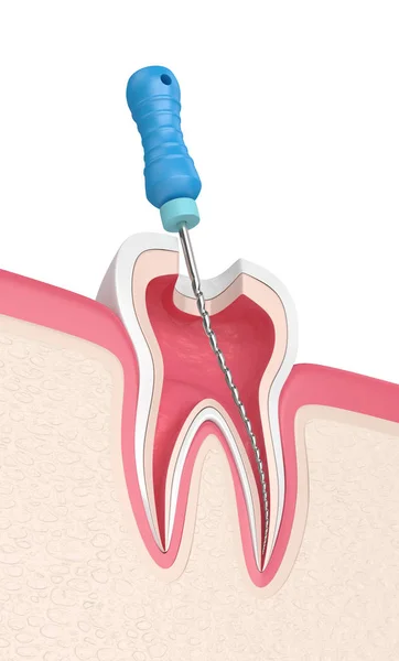 3d визуализация зуба с эндодонтическим файлом в деснах — стоковое фото