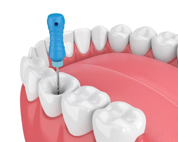 턱에 endodontic 파일의 3d 렌더링 — 스톡 사진