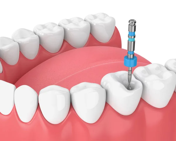 3d render of tooth with endodontic file in jaw — Stock Photo, Image