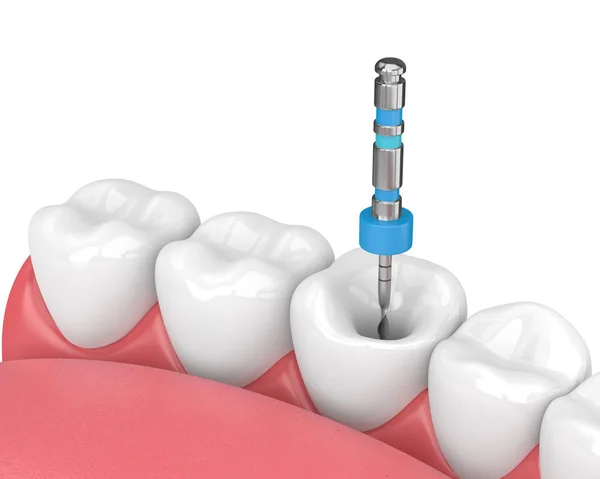 턱에 endodontic 파일의 3d 렌더링 — 스톡 사진