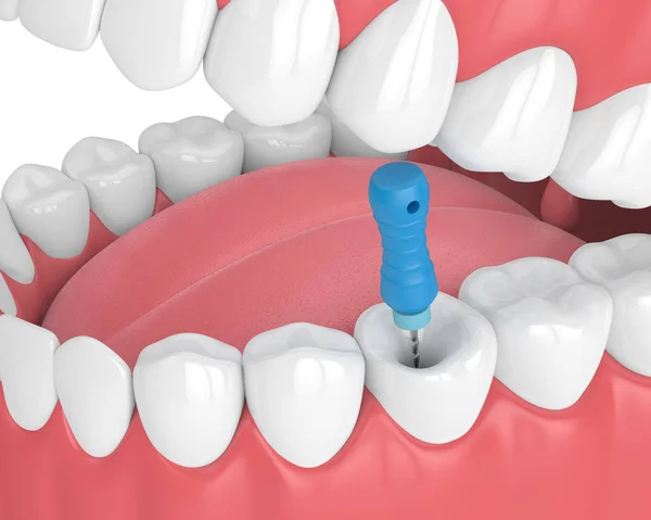 3d renderizado de diente con lima endodóntica en mandíbula — Foto de Stock
