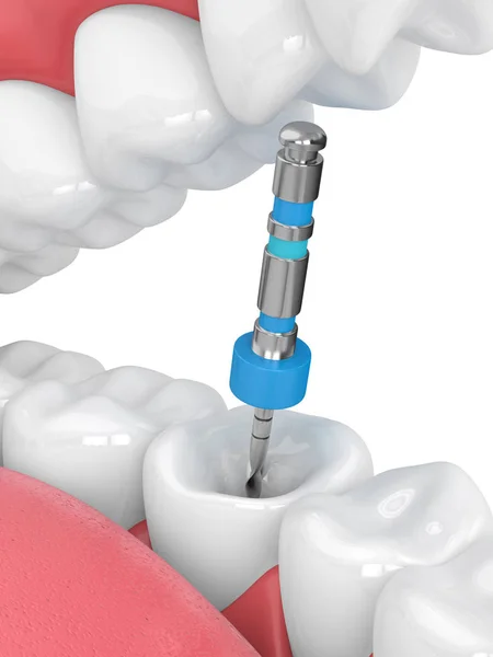 턱에 endodontic 파일의 3d 렌더링 — 스톡 사진