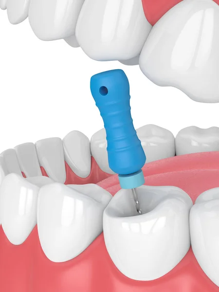 3d renderizado de diente con lima endodóntica en mandíbula — Foto de Stock