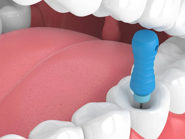 3d rendu de dent avec dossier endodontique dans la mâchoire — Photo