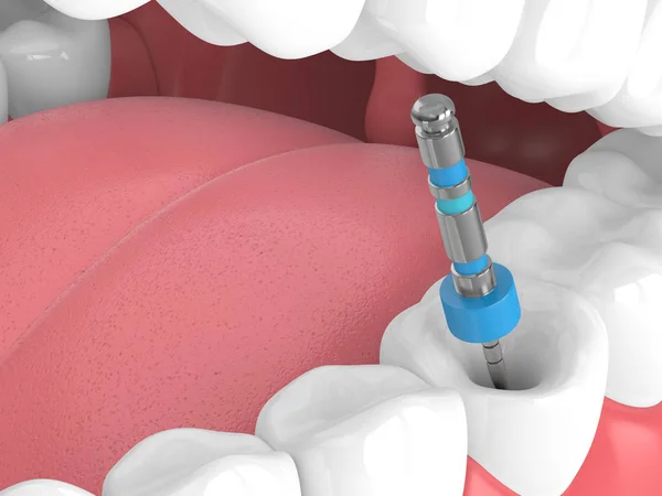 3D καθιστούν δόντι με ενδοδοντική αρχείο στο σαγόνι — Φωτογραφία Αρχείου