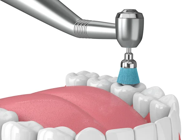 歯科ハンドピースと研磨ブラシで顎の3Dレンダリング — ストック写真