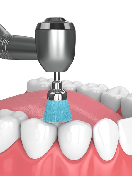 3d render of jaw with dental handpiece and polishing brush — Stock Photo, Image