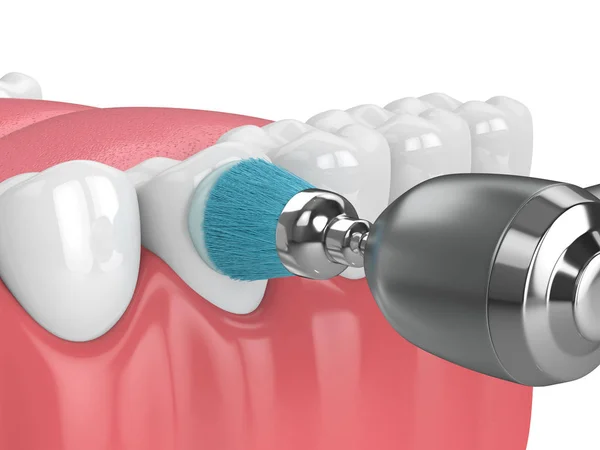 3D-Rendering des Kiefers mit Zahnhandstück und Polierbürste — Stockfoto