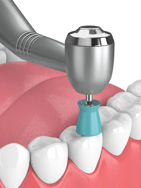 3d renderizado de mandíbula con pieza de mano dental y pulido taza prophy —  Fotos de Stock