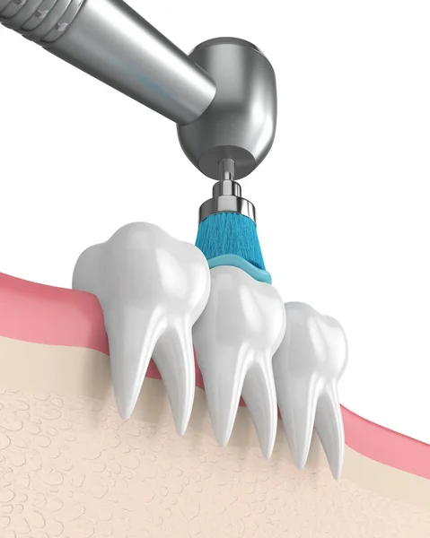 3d renderizado de dientes con pieza de mano dental y cepillo de pulido — Foto de Stock