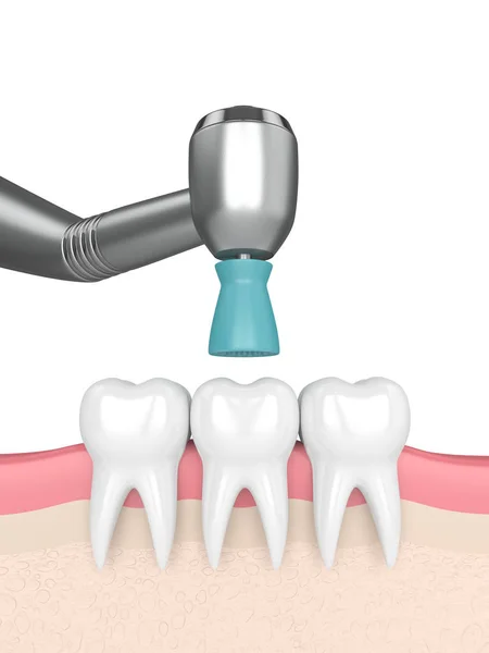 3D απόδοση των δοντιών με Οδοντιατρική χειρολαβή και στίλβωση βούρτσα — Φωτογραφία Αρχείου