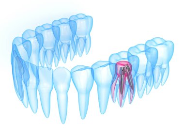 Paslanmaz çelik diş sonrası x-ışını dişlerin 3D render