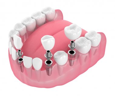 Diş implantları ile çene 3D render