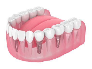 Diş implantları ile çene 3D render