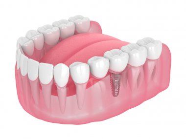 implant destekli diş konsol Köprüsü ile çene 3D render