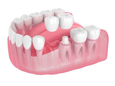 Konsol Köprüsü ile çene 3D render