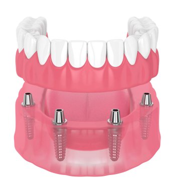 çıkarılabilir tam implant protez 3D render
