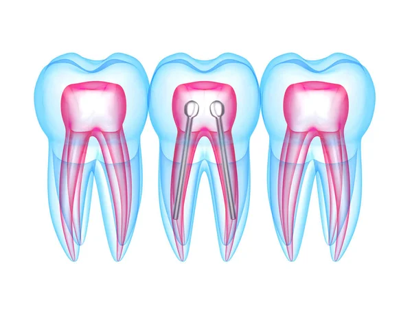 3d renderizado de dientes de rayos X con poste dental de acero inoxidable — Foto de Stock