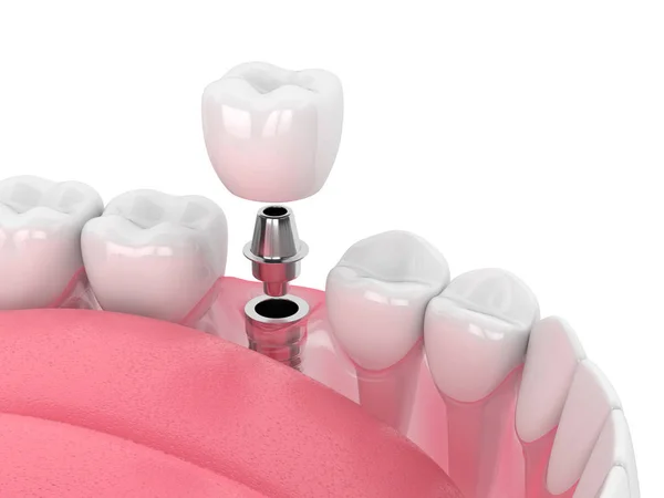 Renderowanie szczęk 3D z implantem dentystycznym — Zdjęcie stockowe