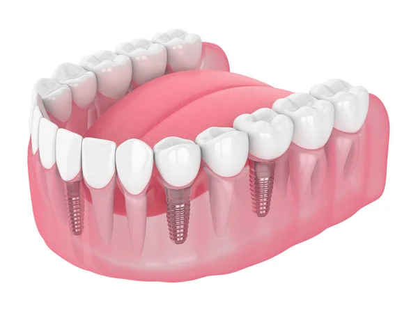 Renderowanie szczęk 3D z implantami dentystycznym — Zdjęcie stockowe