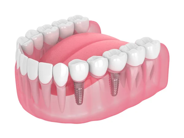 3D rendering av käken med implantat som stöds Dental Bridge — Stockfoto