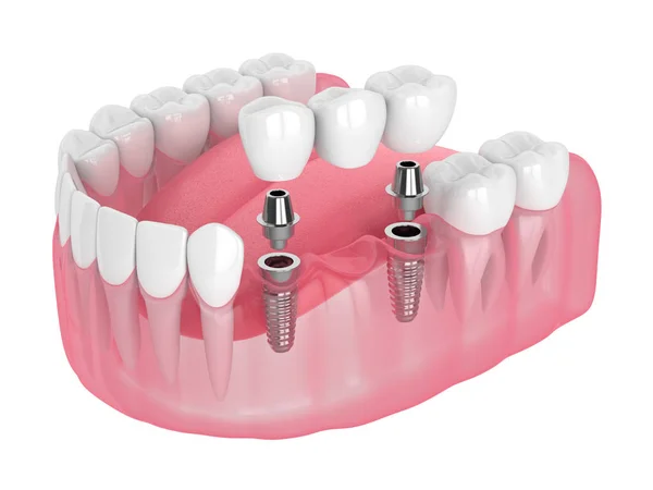 Renderização 3d da mandíbula com implantes ponte dentária suportada — Fotografia de Stock