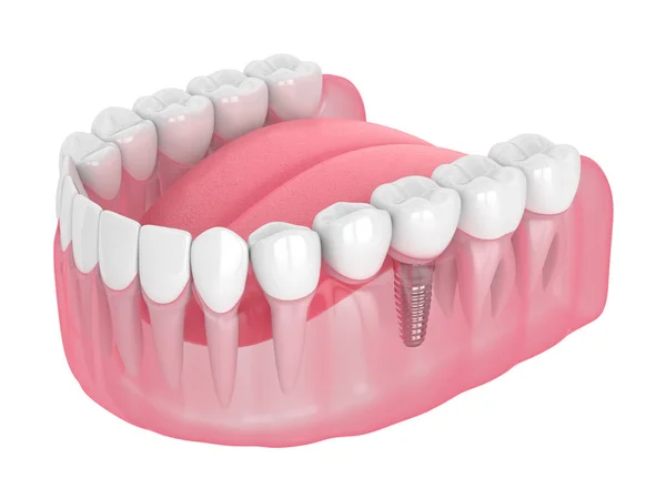 Renderização 3d da mandíbula com ponte cantilever dental suportada por implante — Fotografia de Stock