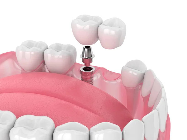 Renderowanie szczęk 3D ze wsparciem implantu zębowego mostu wspornika — Zdjęcie stockowe