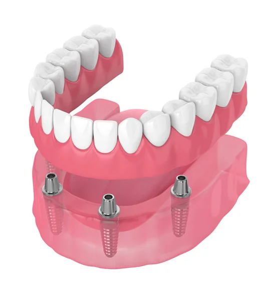 3d render of removable full implant denture — Stock Photo, Image