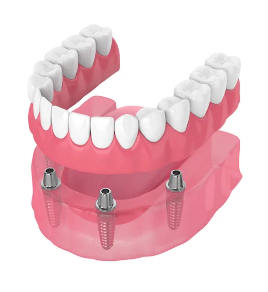 çıkarılabilir tam implant protez 3D render