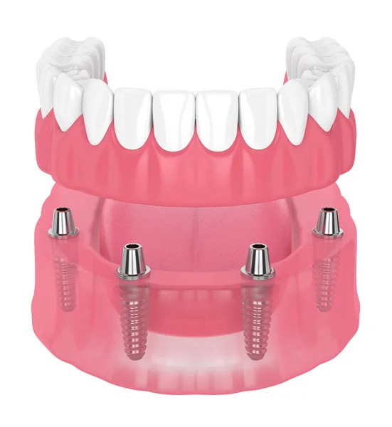 Prostorové vykreslení odnímatelné dentury plného implantátu — Stock fotografie