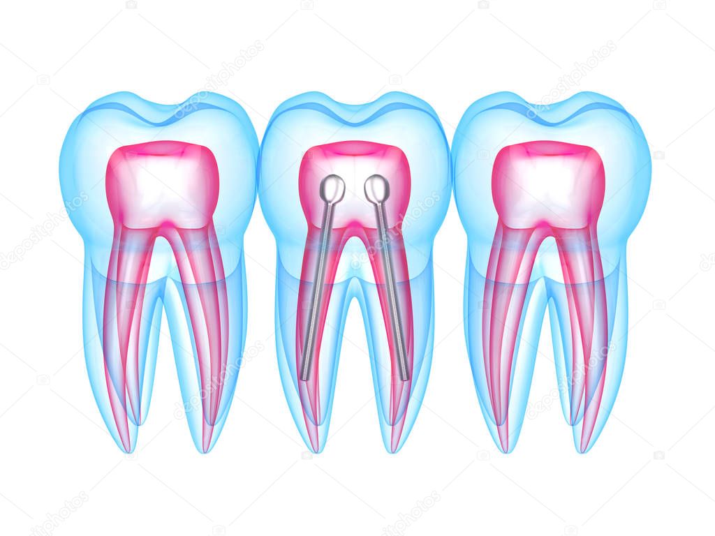 3d render of x-ray teeth with stainless steel dental post