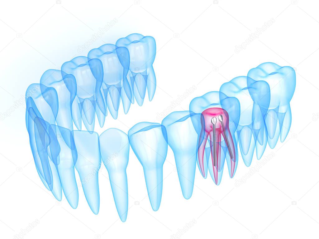 3d render of x-ray toothing with stainless steel dental post