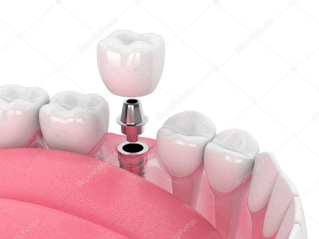 3d render of jaw with dental implant