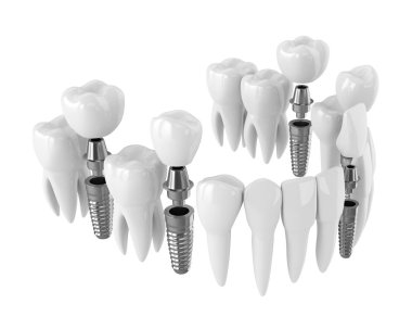Dental implantlar ile toothing 3d render