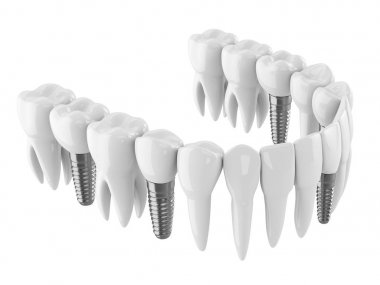 Dental implantlar ile toothing 3d render