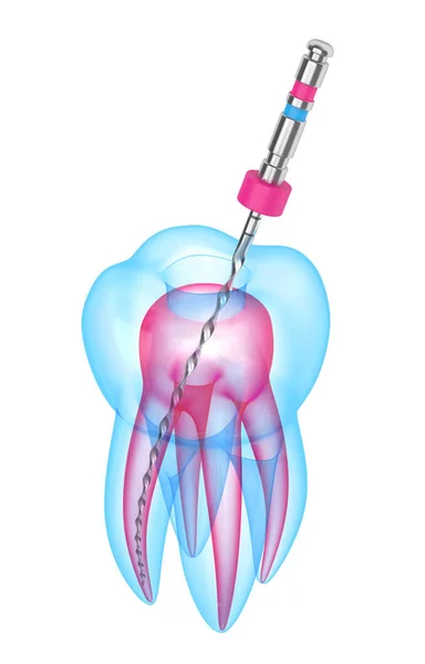 3d render of tooth with endodontic file over white background — Stock Photo, Image