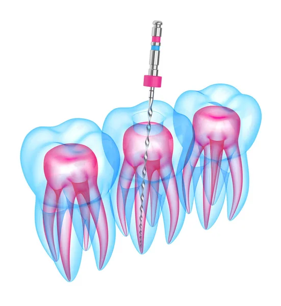 3d render of teeth with endodontic file over white background — Stock Photo, Image