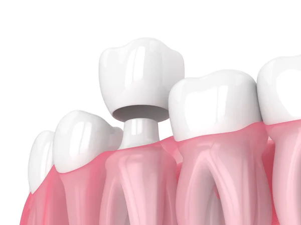 3D render av käke med tänder och tandkrona restaurering — Stockfoto