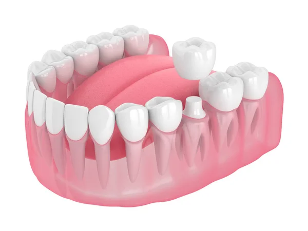 3d renderização da mandíbula com dentes e restauração coroa dental — Fotografia de Stock