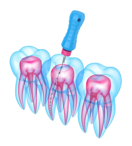 3d render of tooth with endodontic file over white background — Stock Photo, Image