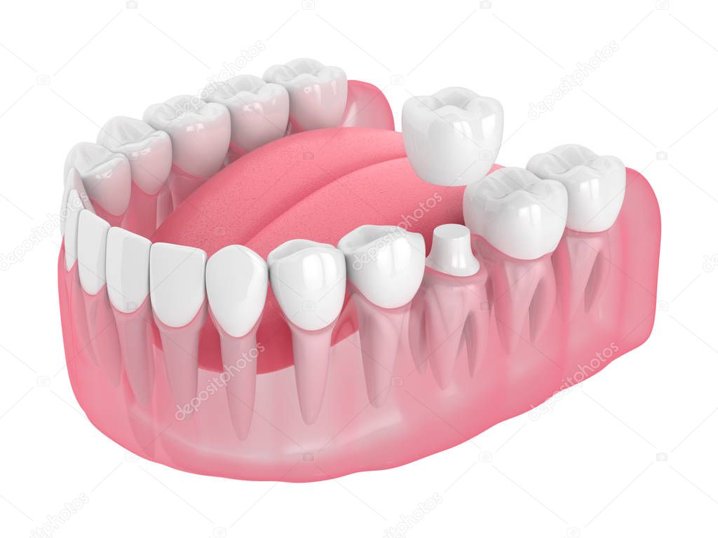 3d render of jaw with teeth and dental crown restoration