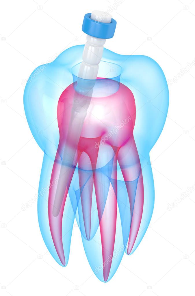 3d render of tooth with fiber post over white
