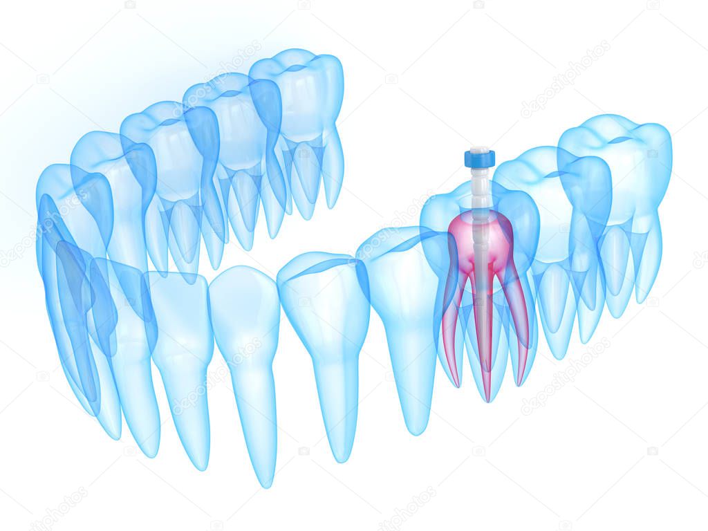 3d render of jaw with teeth and fiber post over white