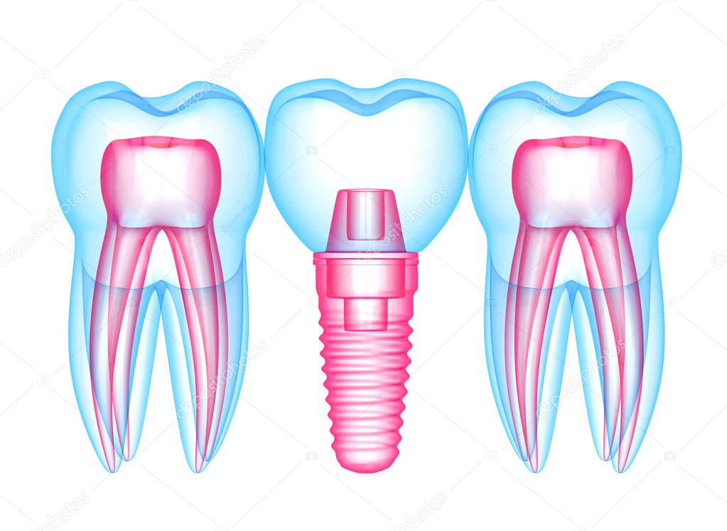 3d render of teeth with dental implant over white 